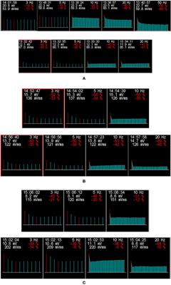 Abnormal decrement on high-frequency repetitive nerve stimulation in congenital myasthenic syndrome with GFPT1 mutations and review of literature